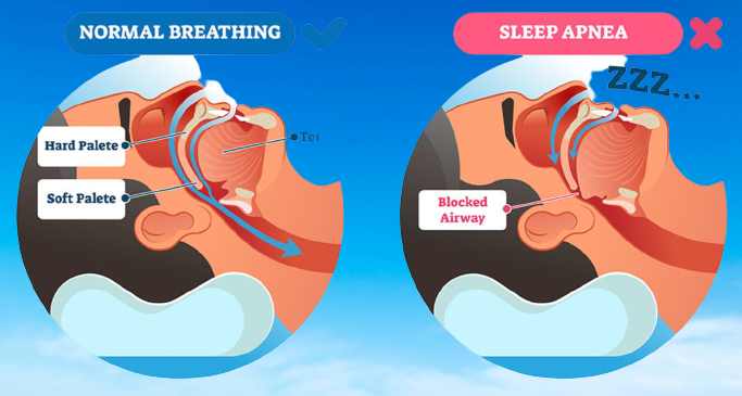 Sleep Apnea